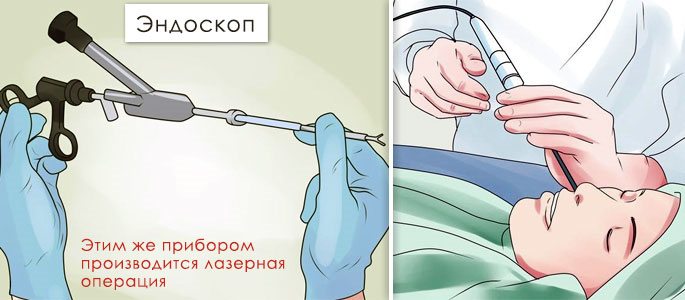 Эндоскоп и лазерно-эндоскопическая операция