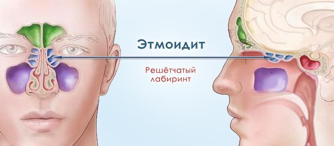Расположение решетчатых пазух при этмоидите