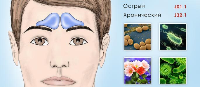 Виды и коды МКБ 10 у фронтита