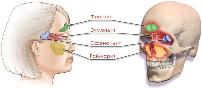 Виды и формы риносинусита