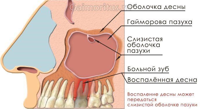 Схема зарождения одонтогенного гайморита