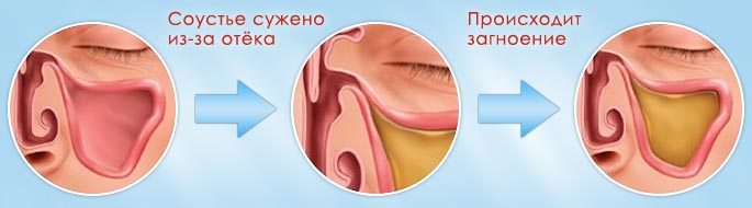 Схема процесса загноения в пазухе