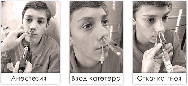 Анестезия слизистой, ввод ямик-катетера, откачка гноя