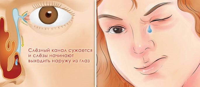 Слезотечение при отеке