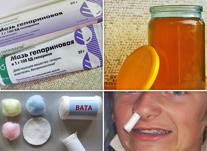 Турунду (тампон ватный) смоченный в смеси меда с анестезином закладываем в нос