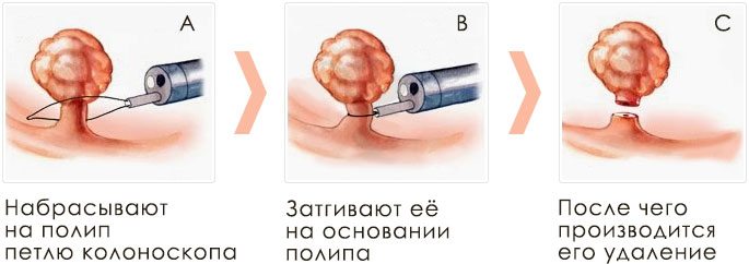 Как производится удаление полипа схема