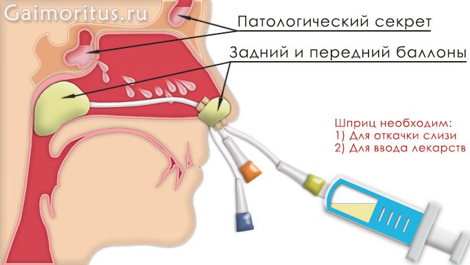 Процедура откачка Ямик-катетером