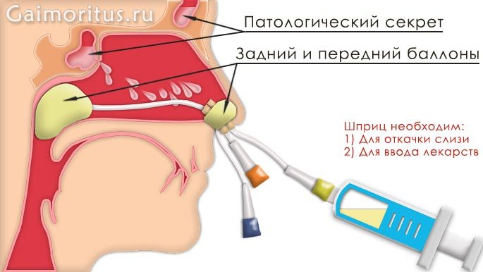 Схема ямик-катетера в носовой полости