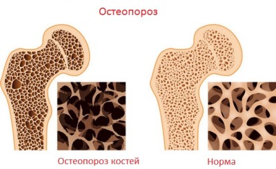остеопороз
