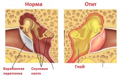 отит