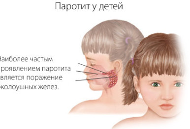 паротит