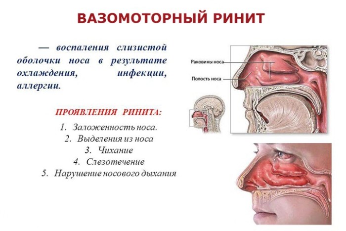 Вазомоторный ринит