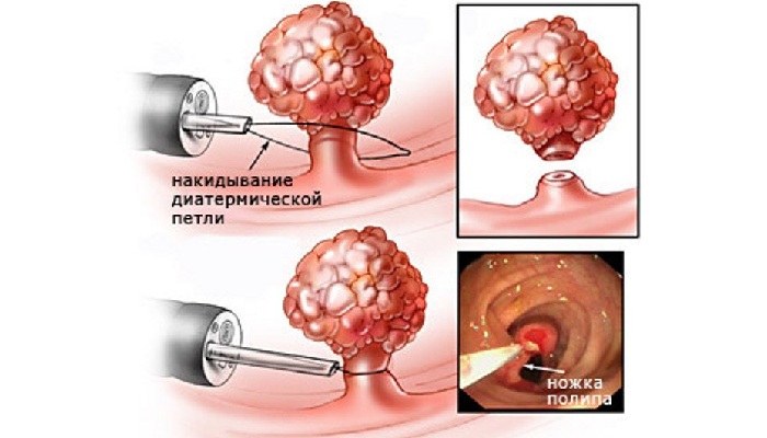 Удаление полипов