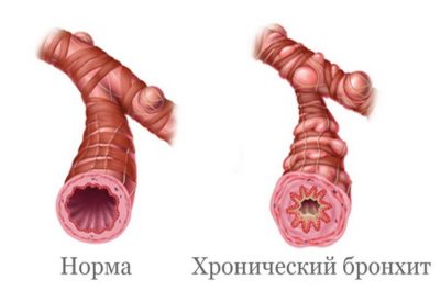 хронический бронхит