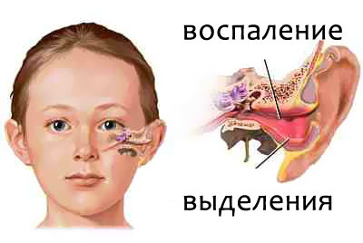 отит