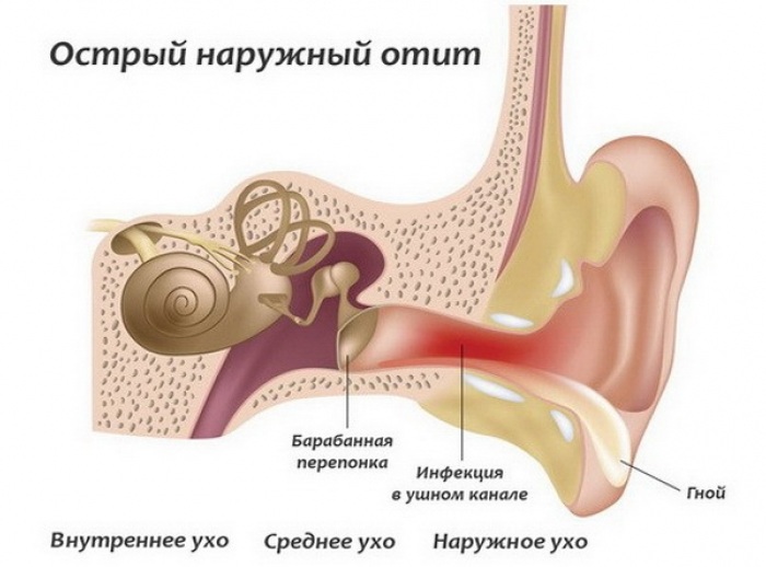 Отит