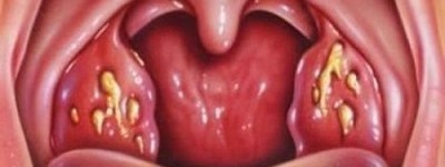32_angina-lechen