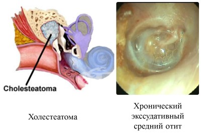 холеастома