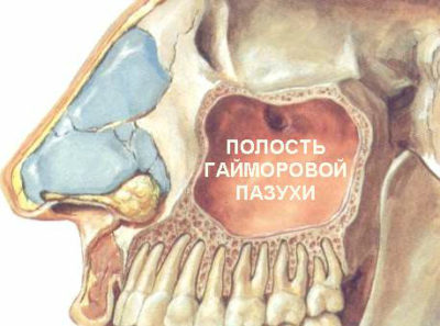 хроническое воспаление гайморовых пазух