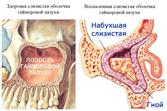 Пазухи при гайморите