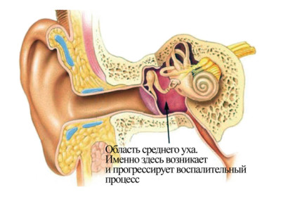 отит