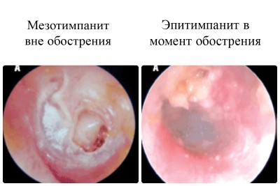 отит