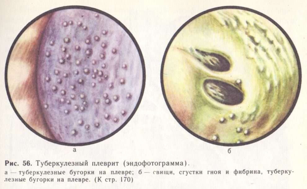 Туберкулезный плеврит