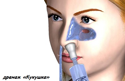 Дренаж Кукушка