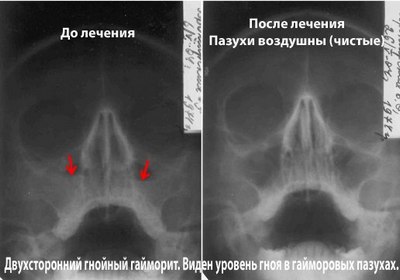 Гайморит рентген