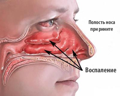 Отечность носовой полости