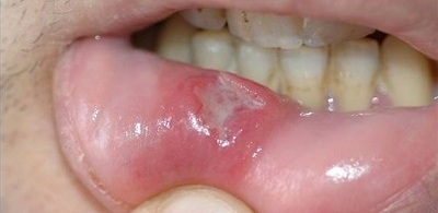 750x500-ehow-images-a04-so-43-remedy-canker-sores-800x800