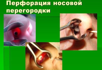 Перфорация