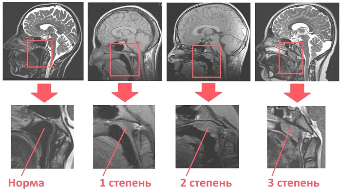 Степени увеличения аденоидов