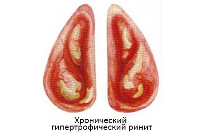 Гипертрофическая форма