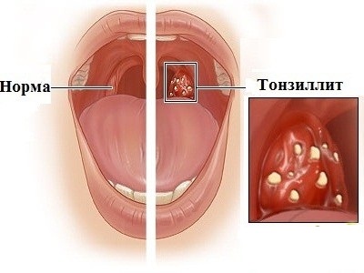 тонзиллит
