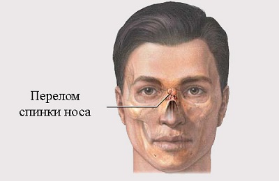 Сломанный нос