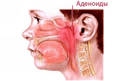 Заболевание у детей