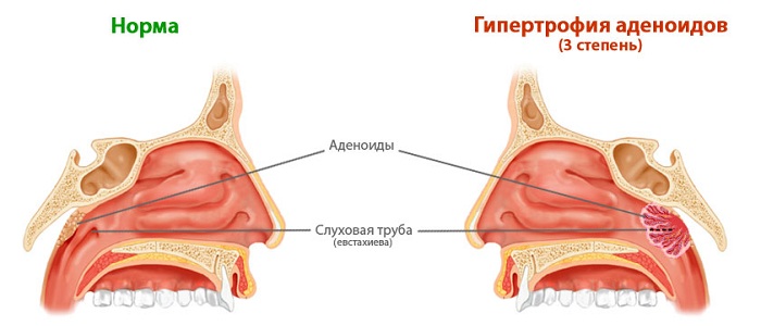 3 степень