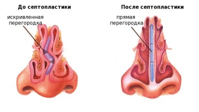 Септопластика