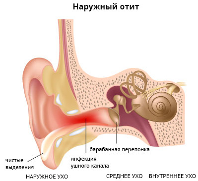 отит