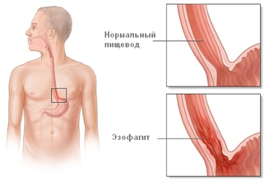 Болезнь Эзофагит 