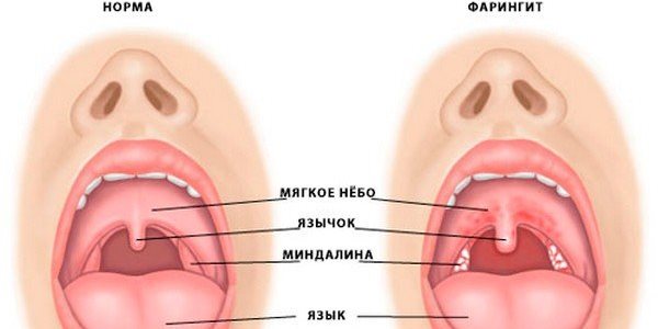 Болезнь горла