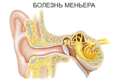 Болезнь Меньера