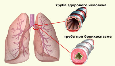 бронхоспазм