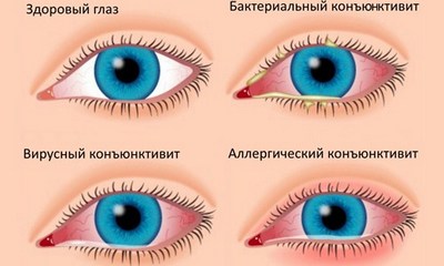 Коньюктивит