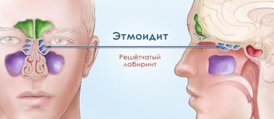 этмоидит