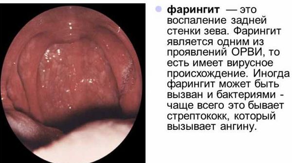 Фарингит