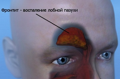 Фронтит