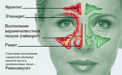 Фронтит