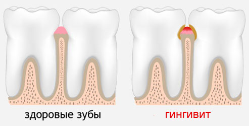 Гингивит